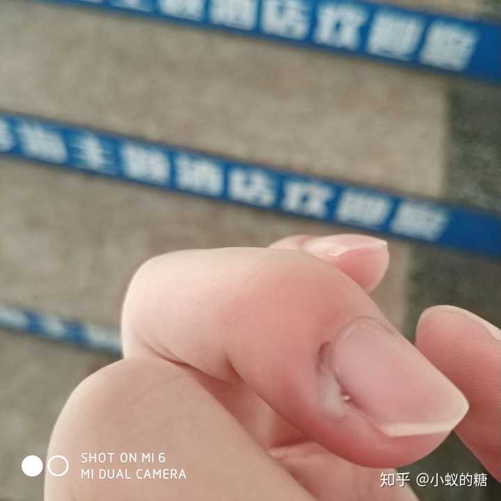 倒刺拔不好有什么后果