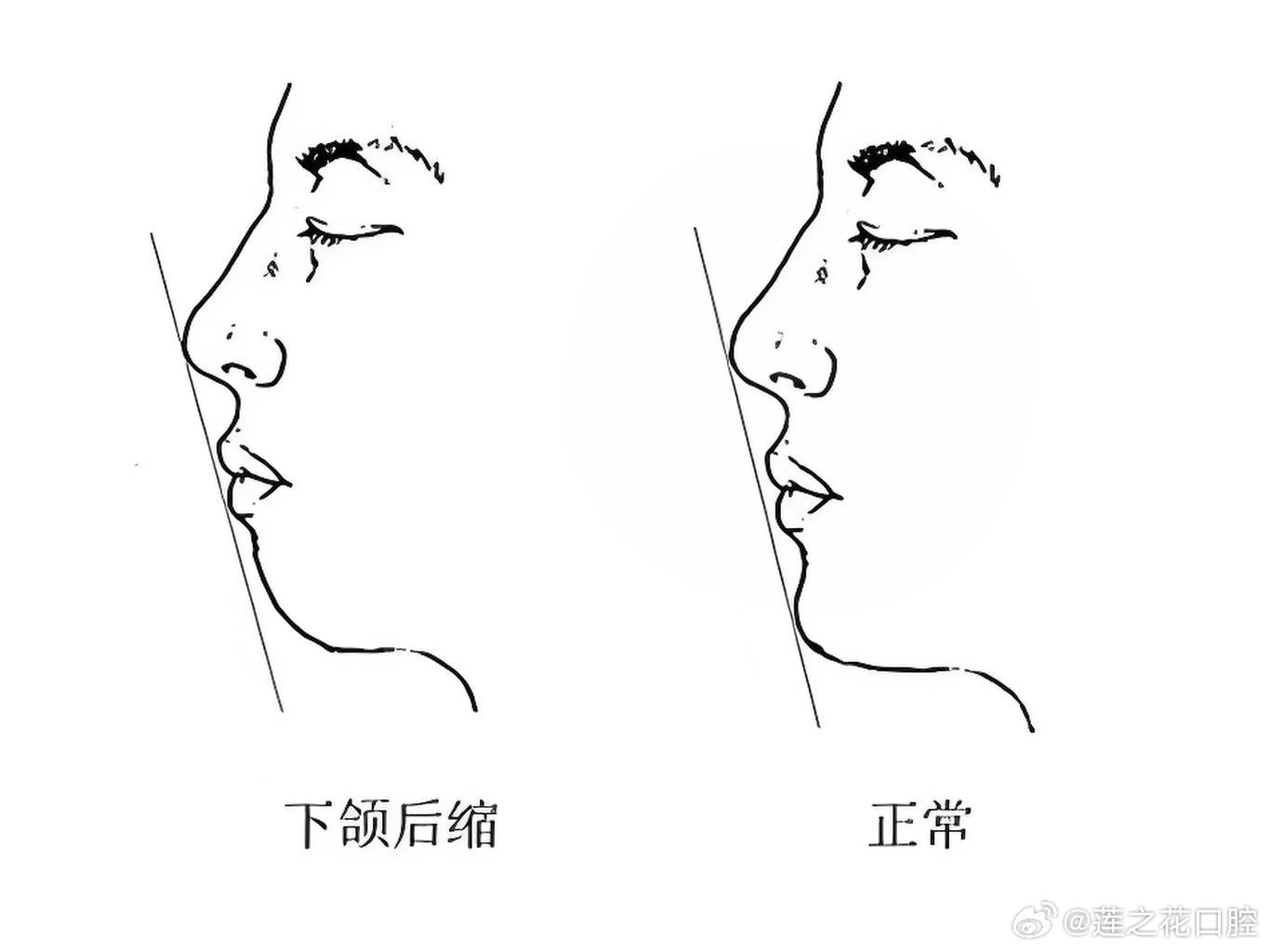 医生称森碟下巴后缩可能影响口腔功能，探究与应对