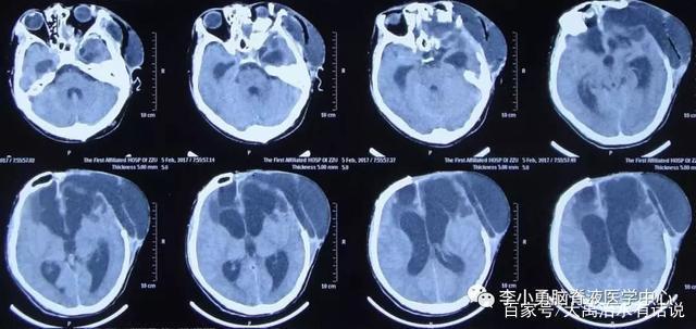 車禍腦部CT主要關注什么？揭秘腦部掃描的重要性與細節洞察