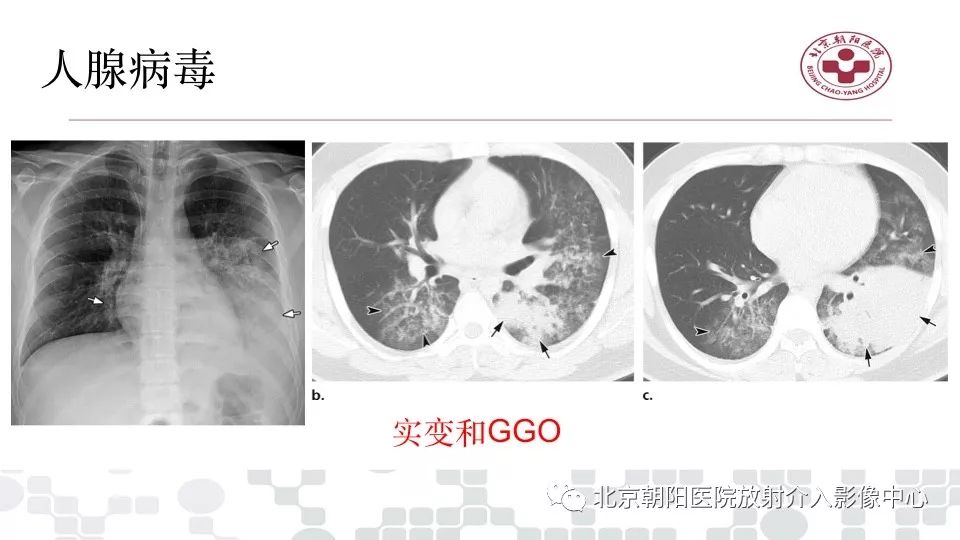 得甲流一周變成病毒性肺炎怎么辦