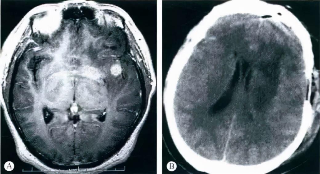 車禍后CT查出腦瘤醫生未告知？一文探究事件真相及其影響