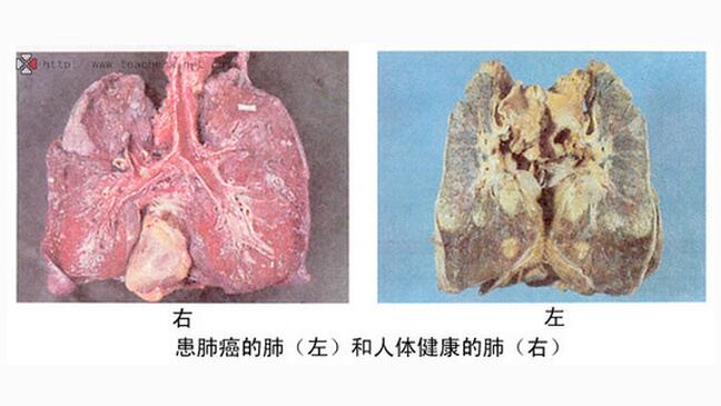 建议，奇迹再现！74岁肺癌晚期患者如何逆转命运，纯中药消除肿瘤疑云重重