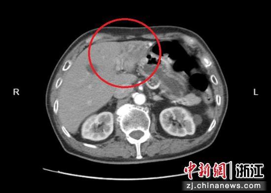 男子未患癌竟遭胆囊切除并化疗三次，医学界震惊！究竟是何原因？