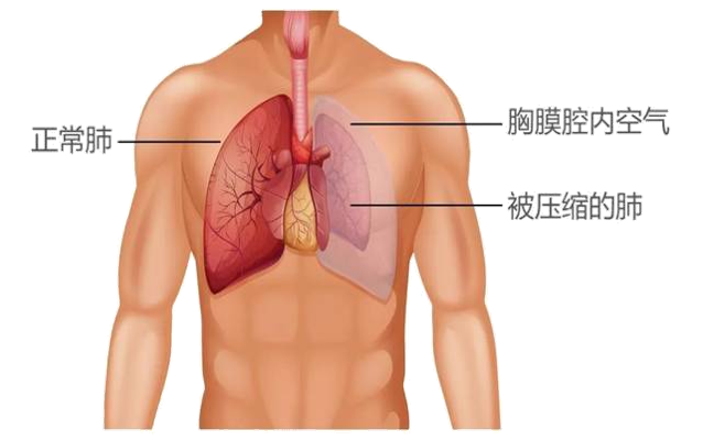 高瘦男性警惕！气胸隐患在你身边！