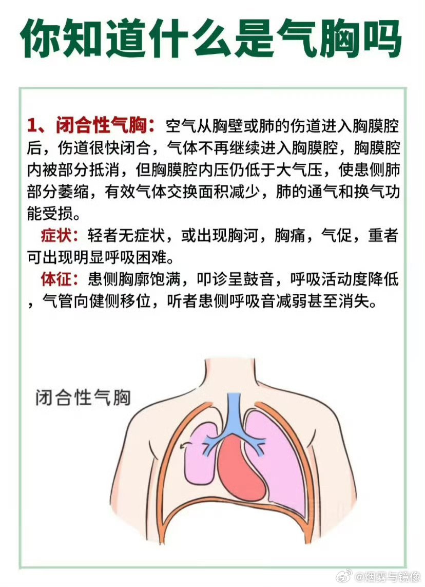 高瘦男性警惕气胸隐患，无声的健康杀手正在靠近！