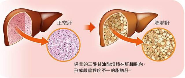 男子过度节食治疗脂肪肝，结果脂肪暴增，这是怎么一回事？