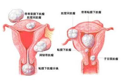 女子愛生悶氣子宮驚現八瘤，情緒與健康究竟有何關聯？